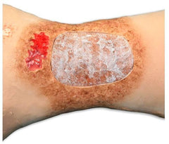 diabetic  wounds model