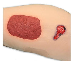 Diabetic neuropathy Foot leg ulcer model