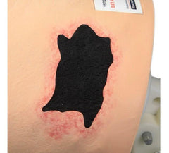 diabetic gangrene cellulitis pyoderma model