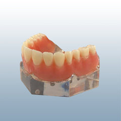 Six Implants Model Overdenture