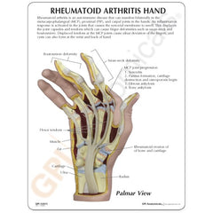 Hand With Rheumatoid Arthritis Model