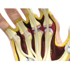 Hand With Rheumatoid Arthritis Model