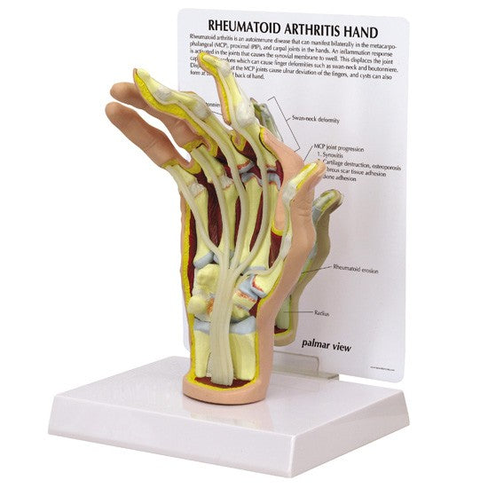 Hand With Rheumatoid Arthritis Model