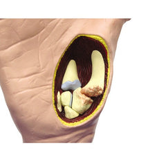 Hand With Osteoarthritis Model