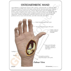 Hand With Osteoarthritis Model