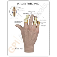 Hand With Osteoarthritis Model
