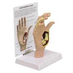 Hand With Osteoarthritis Model