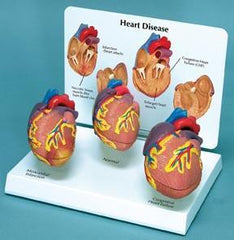Heart Disease Model Normal Myocardial Infarction Congestive Heart Failure