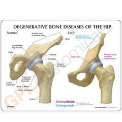 Hip Joint 4 Stage Degenerative Bone Disease Models