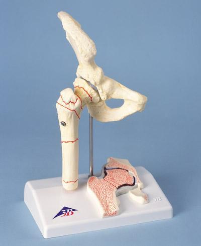 Hip Joint Model Fractured Femoral & Hip Osteoarthritis
