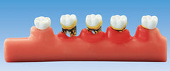 Periodontal Disease Demonstration Model 2x Enlarged Size