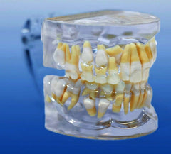 orthodontic model impacted cuspid tooth