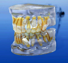 impaction cuspid tooth model