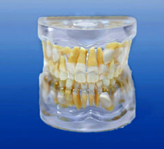 impacted cuspid tooth orthodontic model