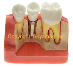 Dental Implant 3 Unit Bridge 3 Crowns Set of 6 Parts Model