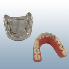 Overdenture 4 Implants Model