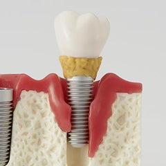 Dental Periodontal Gum Disease Stages