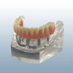 5 implants dental model