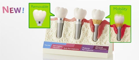 peri implant mucositis model