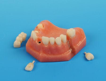 Dental Implant Model 3 Unit Bridge - Single Tooth Implant 4 parts