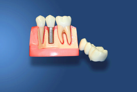 Dental Implants 3 Units Bridge 2 Crowns Reconstruction