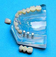 dental 4 implants bridge model 