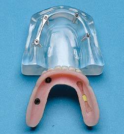 dental 4 implants ball anchor hader bar