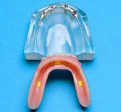 four implants overdenture model