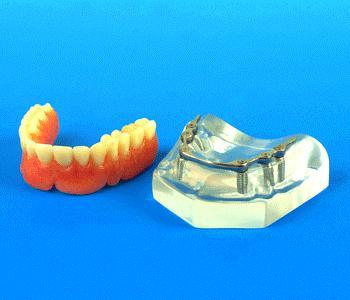 dental 6 Implants model
