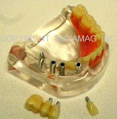 six implants hader bar overdenture