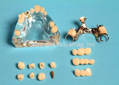 dental implant model veneer bridges inlay restoration