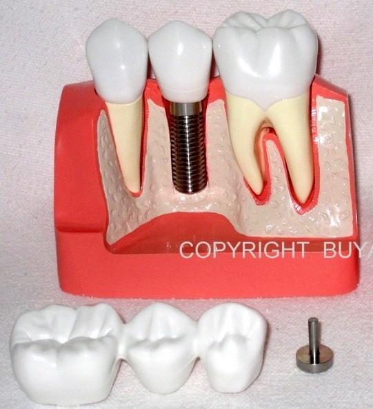 Dental Implant 3 Unit Bridge 3 Crowns Set of 6 Parts Model