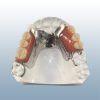 Implant Overdenture Partial locator framework model