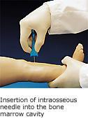 Intraosseous Infusion & Injection Leg Training Simulator Newborn or Year Old