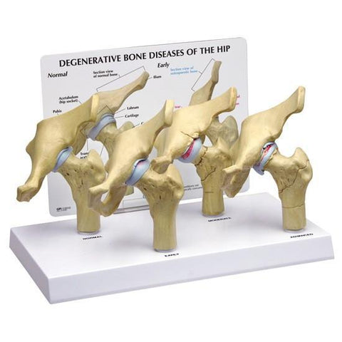Hip Joint 4 Stage Degenerative Bone Disease Models