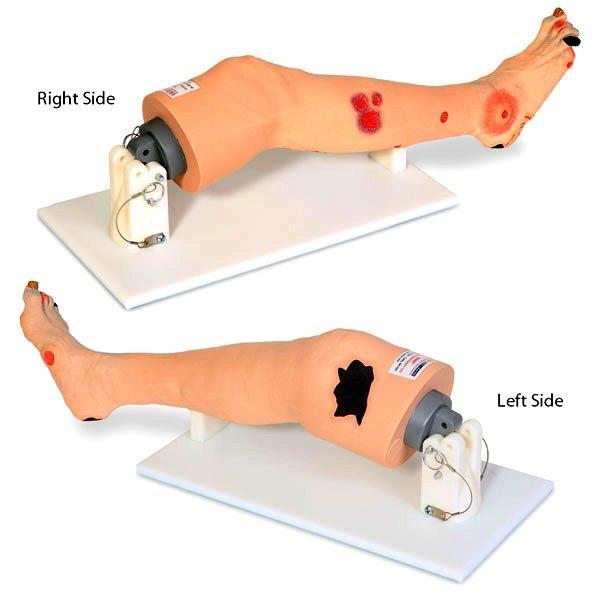 diabetic neuropathy foot wounds model