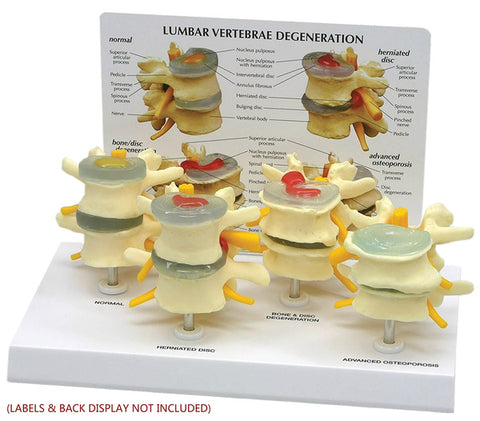 lumbar disk degeneration 4 stage model