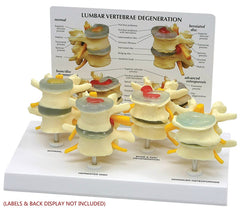 lumbar disk degeneration 4 stage model