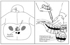 Spine Lumbar Phantom Injection Procedures Fluoroscopic Image