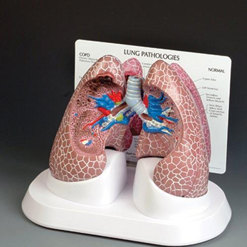 Lungs Pathologies Full-Size 2- Sided Model