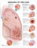 Lungs Disease Poster