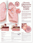Chronic Obstructive Pulmonary Disease Poster