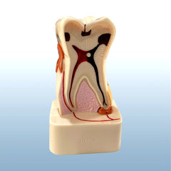 pathological molar model