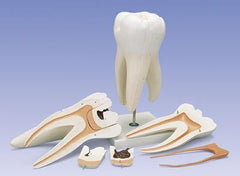 Three Root Molar With Dental Caries 6 Part, Giant Model