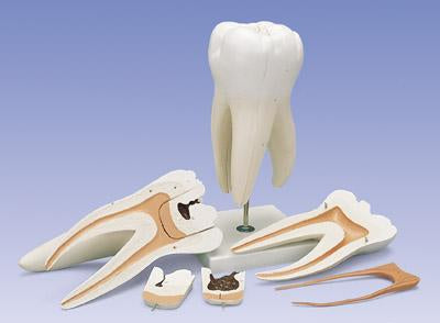 Three Root Molar With Dental Caries 6 Part, Giant