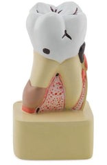 Molar tooth pathology model