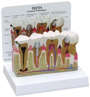 teeth gums didease pathologies model