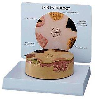 skin cancer model