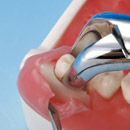 tooth extraction model