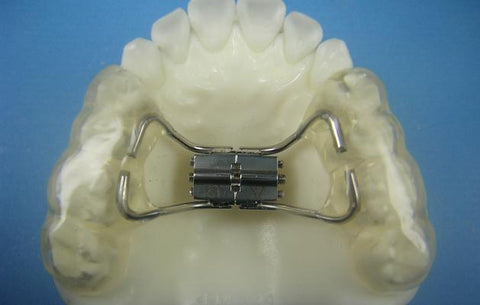 Bonded Rapid Palatal Expander Orthodontic appliance Model